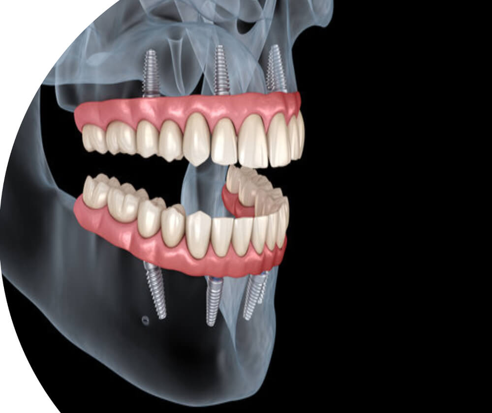 all-on-4-dental-implants-chennai-india-doctorprem