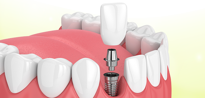 single-tooth-implant-cost-in-india