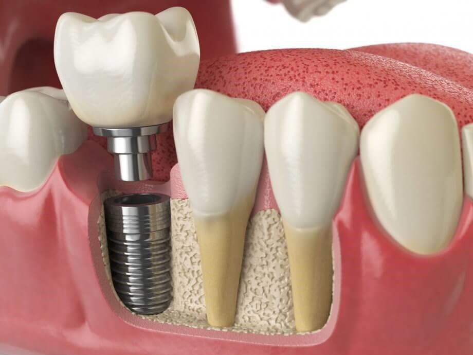 How Strong Are Dental Implants