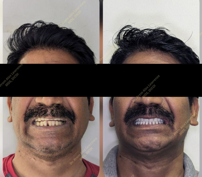 full-mouth-dental-implants-cost-in-india