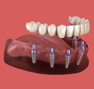 full-mouth-dental-implants-cost