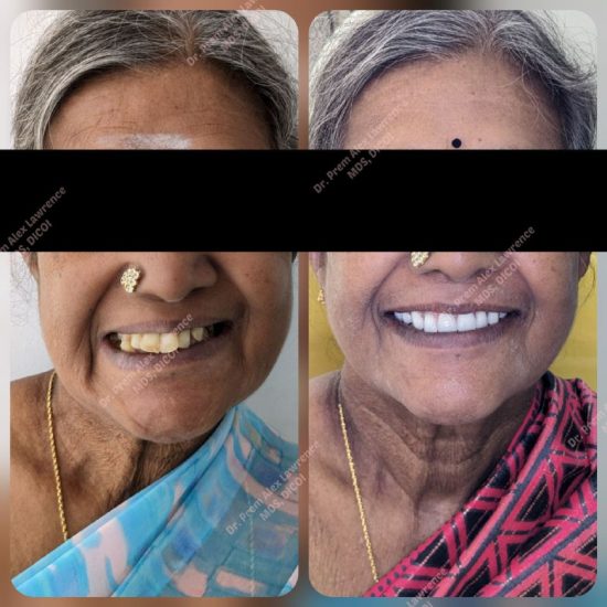 all-on-6-dental-implants-cost-in-india